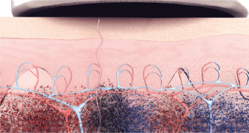 PicoWay Picosecond Pigmentation Removal (Photoacoustic Effects)