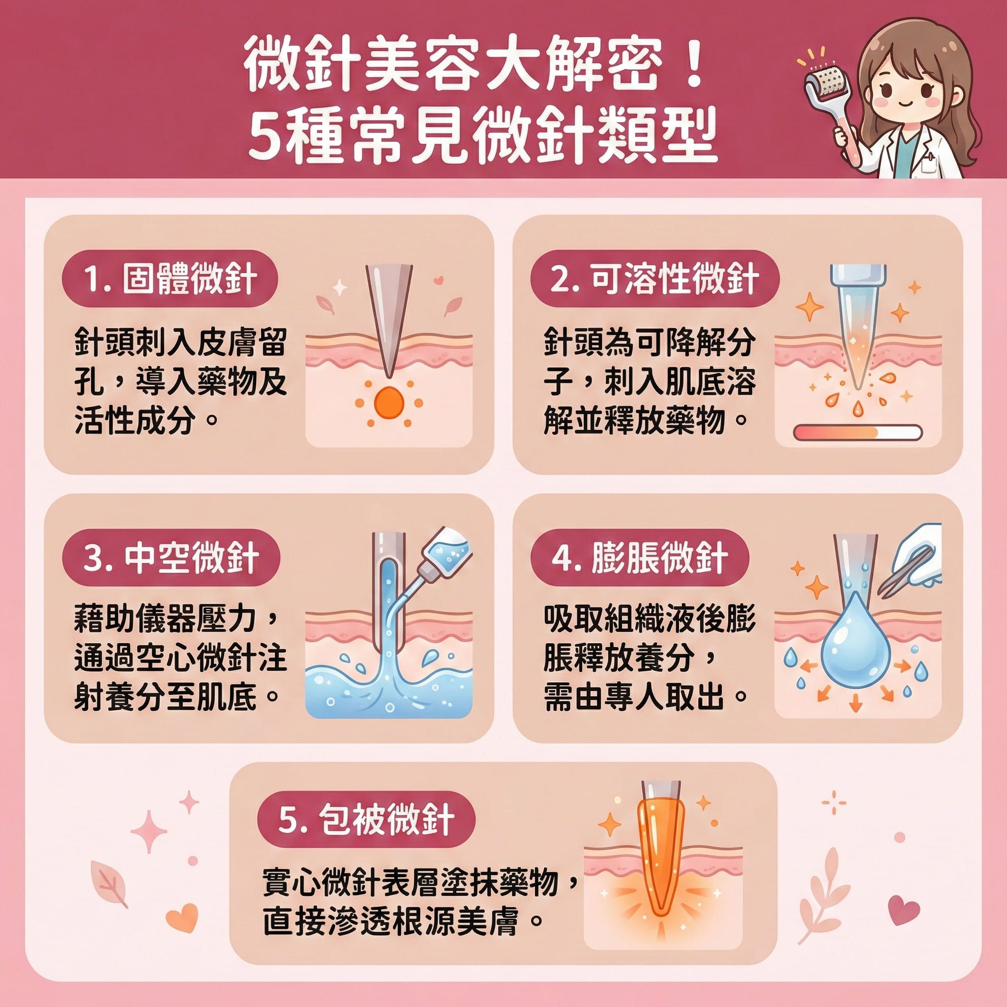 這是一張正方形扁平化的台灣健康部落格風格資訊圖表,詳細介紹微針與射頻微針的5大類型。圖表說明這種微創治療能穿透角質層與表皮層,直達真皮層。透過微針滾輪或專業儀器,能導入精華(如玻尿酸與專屬精華液),有效刺激血液循環與促進新陳代謝。
療程透過微小創口來修復受損組織,喚醒膠原蛋白與彈性纖維,不僅能刺激膠原增生,更能促進細胞更新。臨床證明能有效對抗凹凸洞與疤痕,達到撫平凹凸洞的效果;針對暗瘡印與黑色素,能減淡暗瘡印及改善色素沉澱。同時幫助清理毛孔,達到收細毛孔、緊緻肌膚、改善粗糙、提升彈性與提亮膚色的全面升級。
圖表提醒,為縮短恢復期及預防發炎,術前可由專業人士塗抹麻醉膏,術後需嚴格注重保濕並避免日曬,以舒緩紅腫。建議尋求皮膚科醫生或合規美容院協助,切勿自行操作。圖表最後強烈推薦體驗完美醫療的專業暗瘡分手療程,安全還原健康平滑肌。