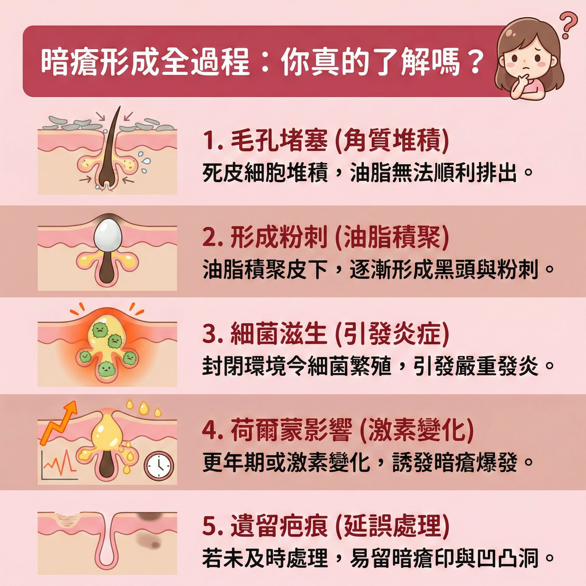 這是一張正方形的扁平化向量醫美資訊圖表，背景採用粉嫩色調，詳細描述暗瘡的形成過程及護理建議。 圖表展示了皮膚角質層及真皮層的結構。首先，死皮與油脂堵塞，未能淨化毛孔，繼而形成粉刺與黑頭。接著，細菌滋生導致發炎，演變成丘疹、帶有膿頭及膿液的暗瘡，甚至惡化成嚴重的囊腫型暗瘡與石頭瘡。若處理不當，傷口癒合後會留下暗瘡印及凹凸洞。

圖表建議日常需促進代謝及軟化角質。發炎期間可使用含有水楊酸、茶樹油或抗菌劑等藥用成分的人工皮或暗瘡貼。這些產品具備透氣防水及隱形貼服的特性，非常適合妝前使用。它們能有效隔離細菌與隔絕污染物，發揮保護傷口及預防感染的作用。只要定時更換，便能吸收分泌物與組織液，幫助吸走膿液。這不僅能消炎殺菌，還能舒緩鎮靜、撫平紅腫及改善紅腫。正確的護理步驟能防止擠壓，從而加速癒合並避免留疤。若皮膚問題持續嚴重，建議尋求如完美醫療等專業機構處理。