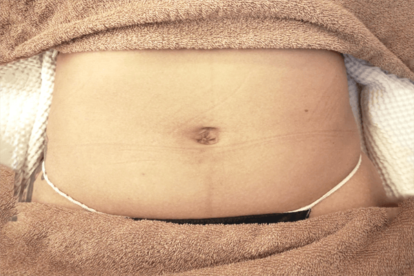 Before Treatment