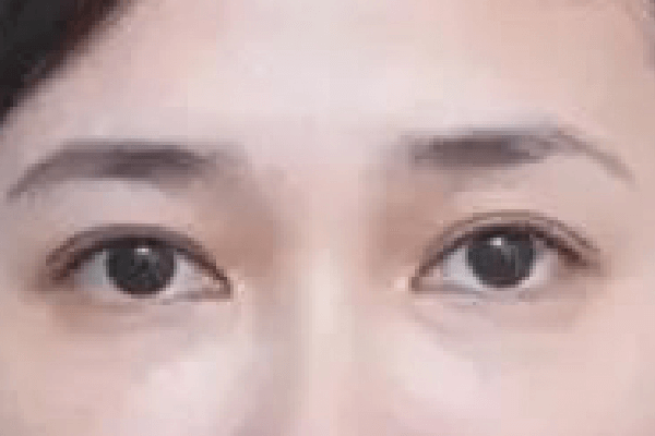 疗程后