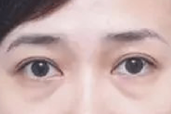 疗程前