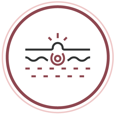 殺滅暗瘡菌 斷尾不復發